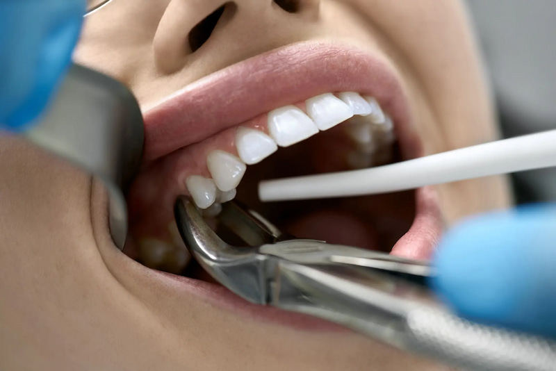 Tooth Extractions: Procedure, Aftercare, and Recovery