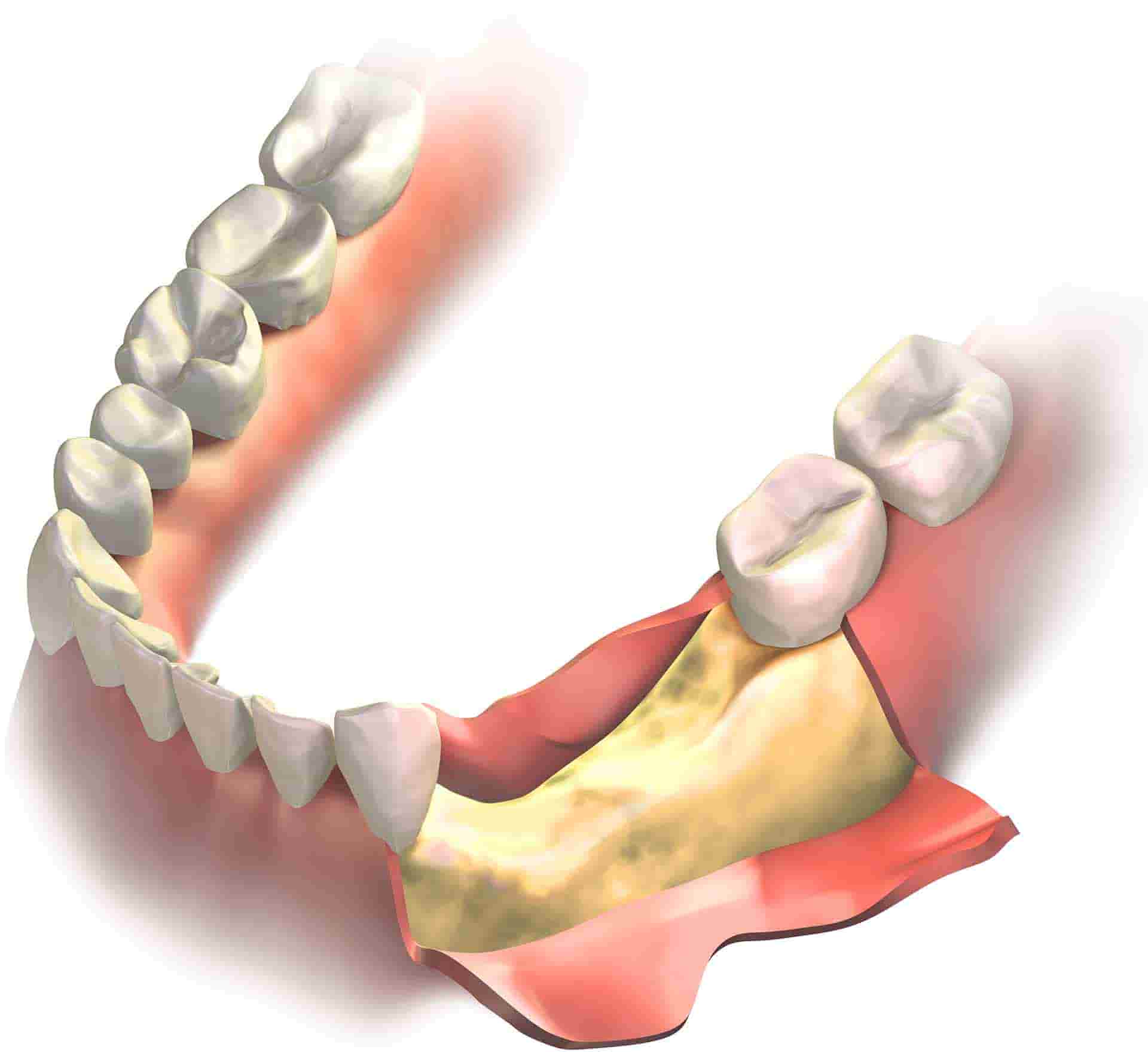 Are Bone Grafts Necessary If You Want to Get Dentures?