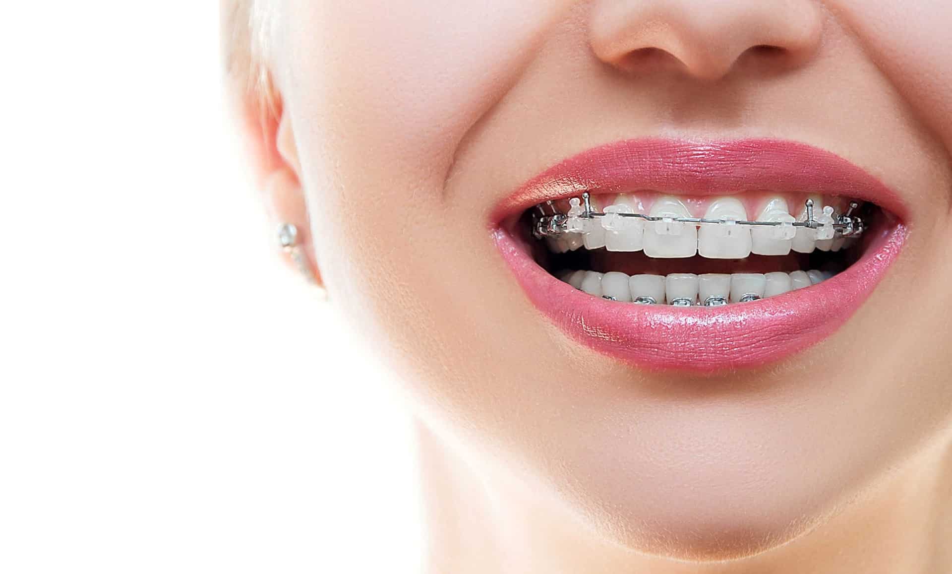Foods to Avoid with Clear Braces: A Simple Guide to Keep Your Smile Safe
