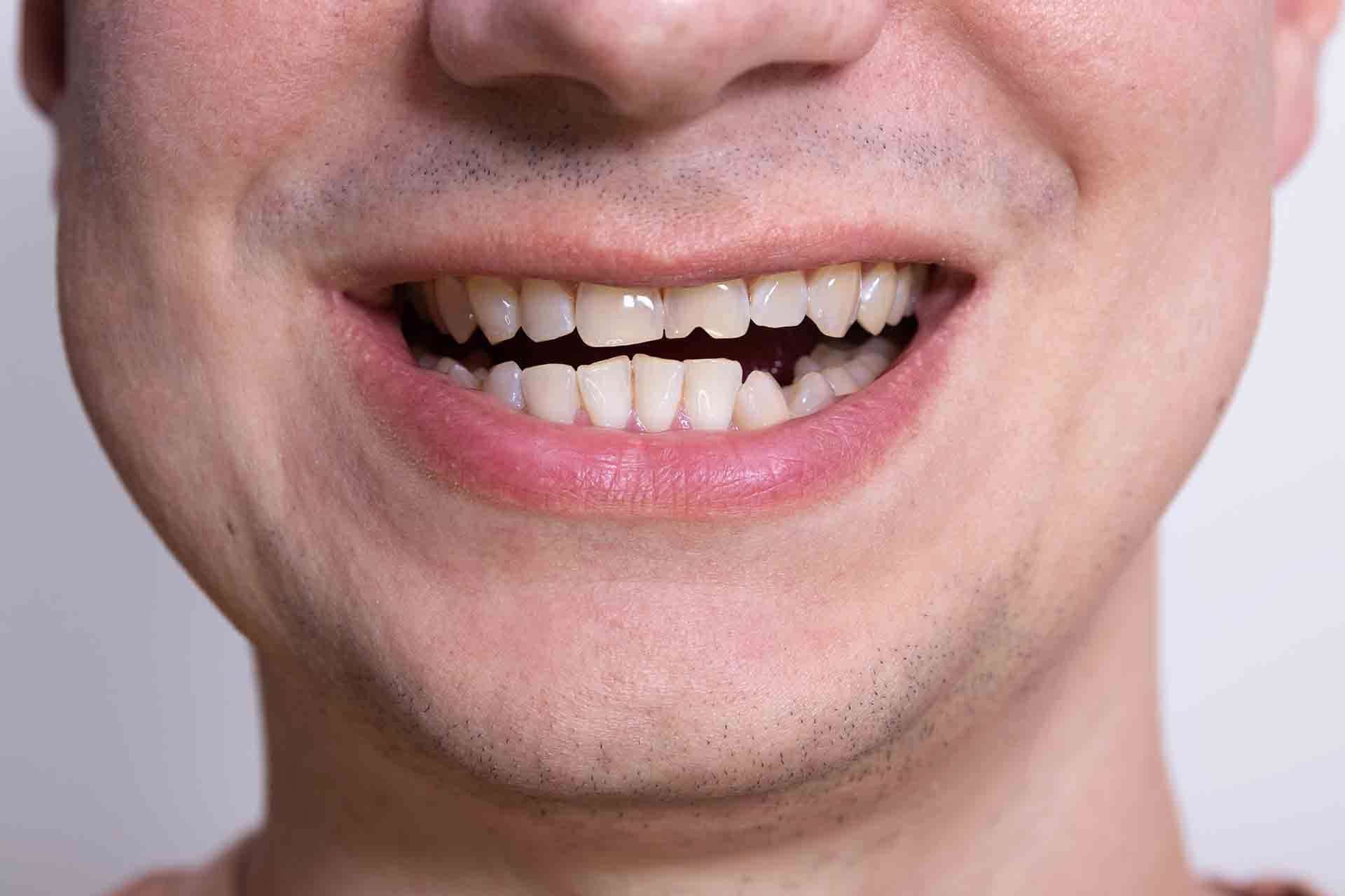 Is a Chipped Tooth an Emergency? Here's What You Need to Know